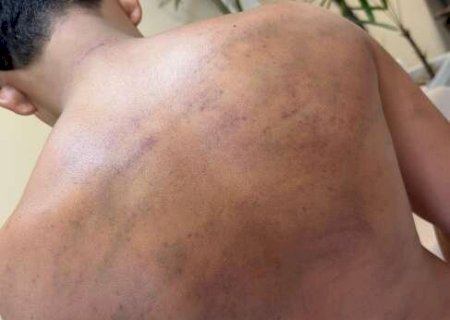 &ldquo;Corretivo&rdquo; em projeto social deixa adolescente ferido e fam&iacute;lia vai &agrave; pol&iacute;cia