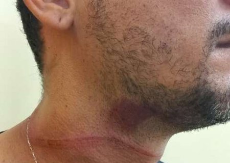 Motociclista fica ferido ap&oacute;s ser atingido por fio solto de telefonia